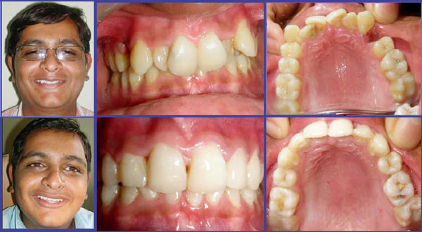 orthodontic case 1