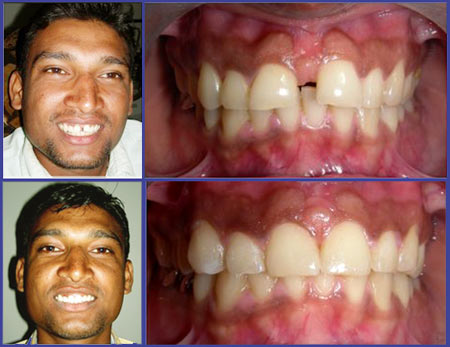 orthodontic case 2