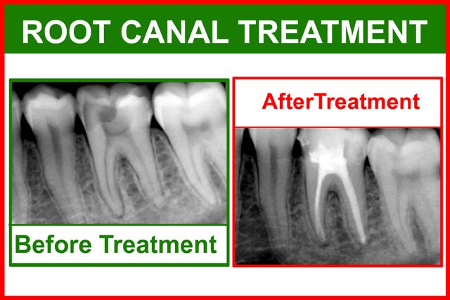 root%20canal